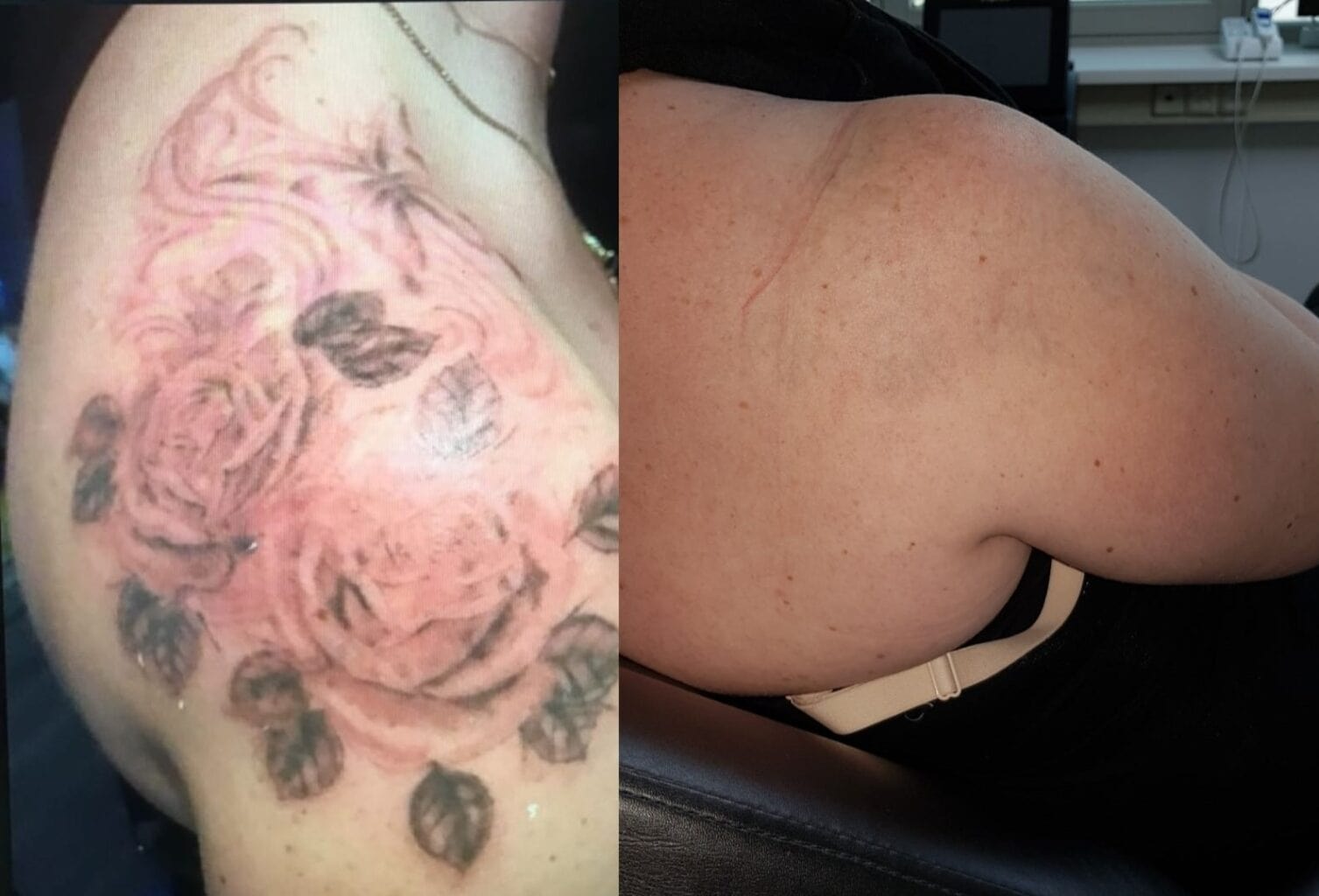 tattoo verwijderen resultaat