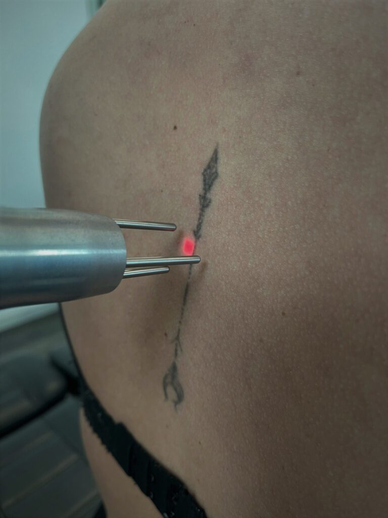 Tattoo verwijderen – welke factoren hebben effect op het lasertraject?